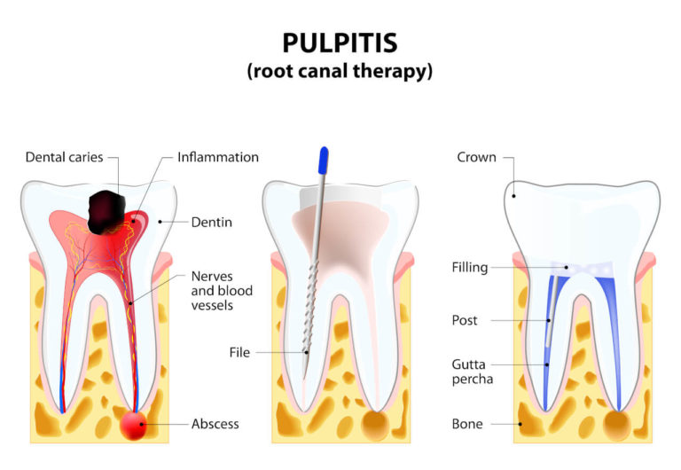 What is An Exposed Tooth Nerve? (Symptoms, Causes, and Treatment)