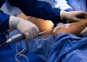 cheapest state for tummy tuck