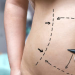 cheapest state for tummy tuck